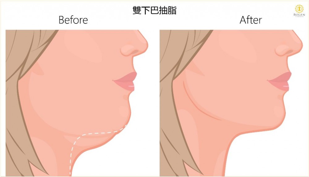 雙下巴抽脂改善,雙下巴抽脂,博恩妍